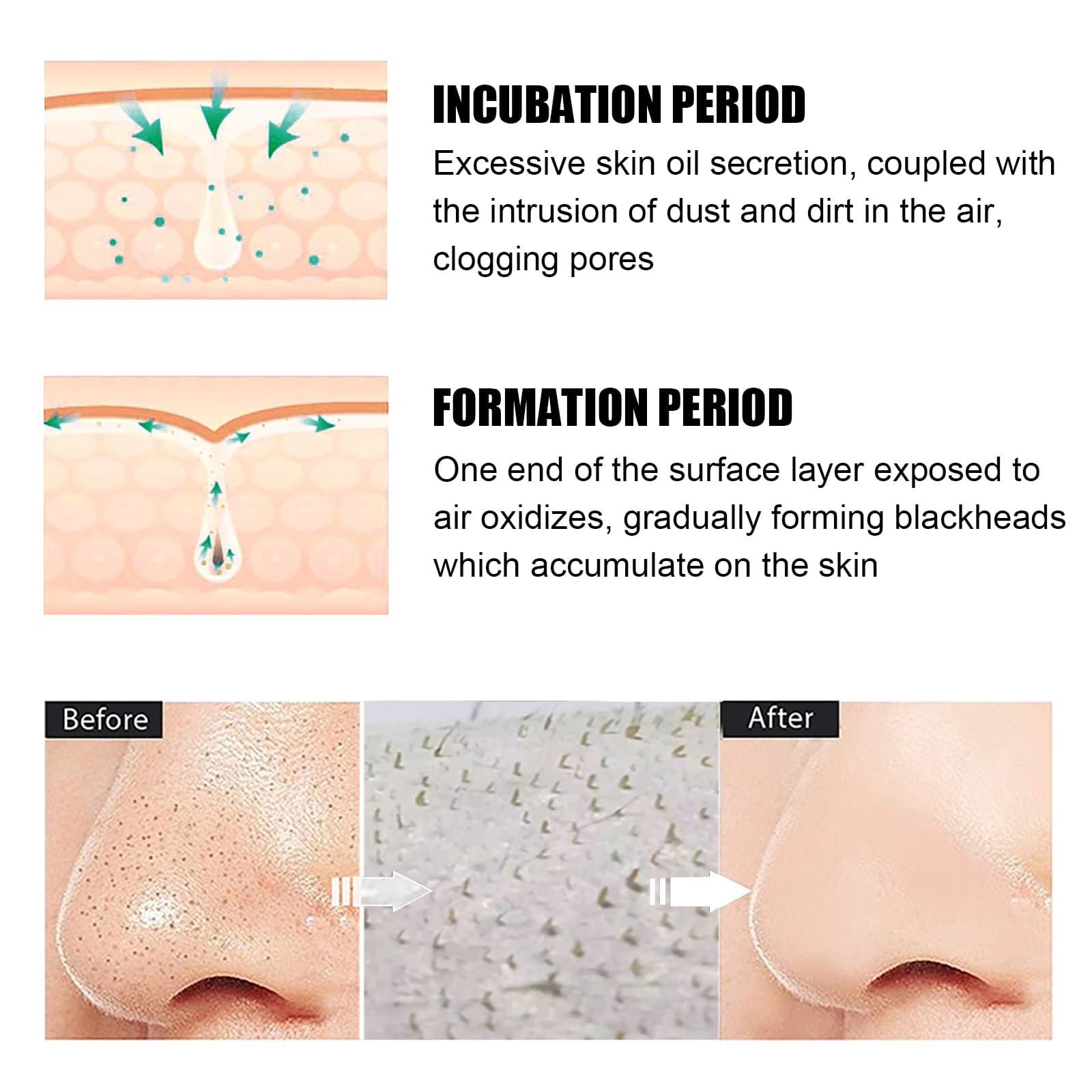 Blackhead Remover Tools -15g Blackhead Creamwith 40Pcs Blackhead Pore Strips 4